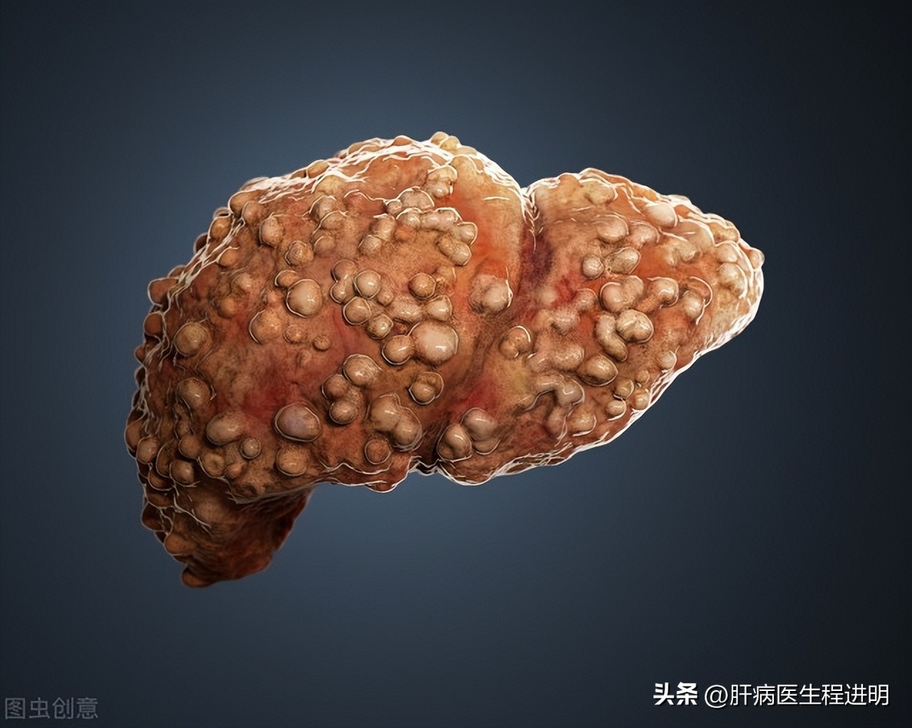 一位肝腹水患者的康复案例,我的肝硬化治疗经验分享