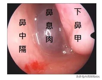 话说息肉：天生我才必有用，身体拒绝“休息之肉”