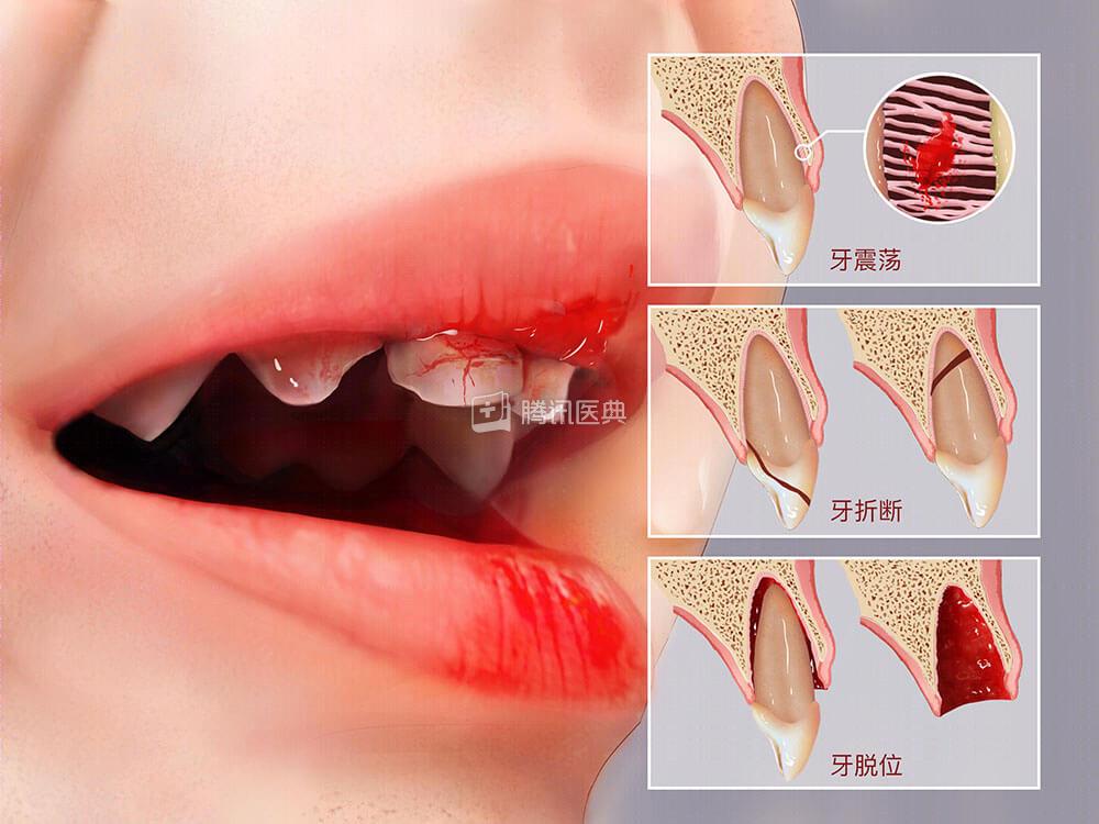 摔了一跤牙碰了半年还隐隐痛,摔了一跤牙齿磨掉了