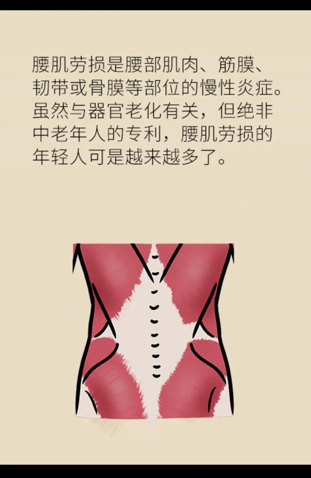 什么是腰肌劳损中医,什么是腰肌劳损