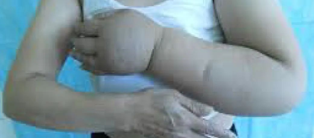 发现|继发性淋巴水肿的潜在治疗靶点及药物