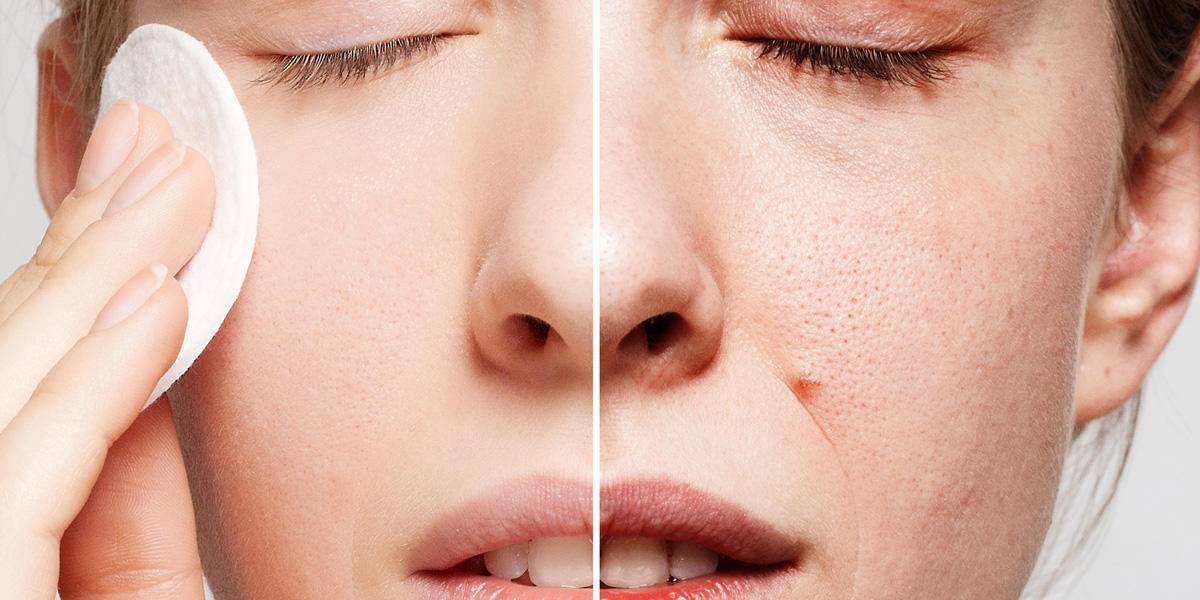 鼻子毛孔粗大如何改善,男士毛孔粗大如何改善