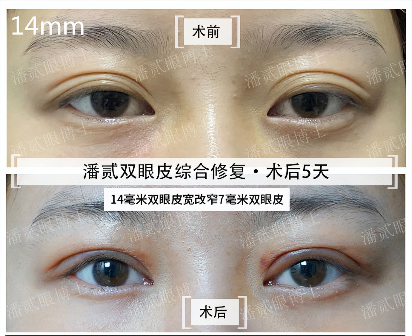 上海宽改窄双眼皮修复案例对比,宽变窄双眼皮修复过程对比