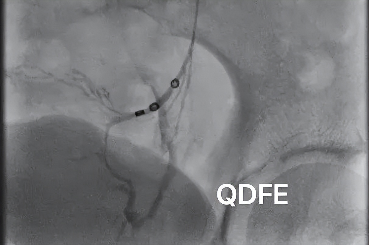 肚子上静脉曲张疼痛还起包,静脉曲张造成的腹痛怎么治