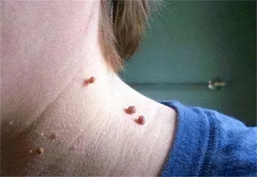 ​女性3个地方痒，或不是过敏，可能是HPV来“敲门”，别不当回事