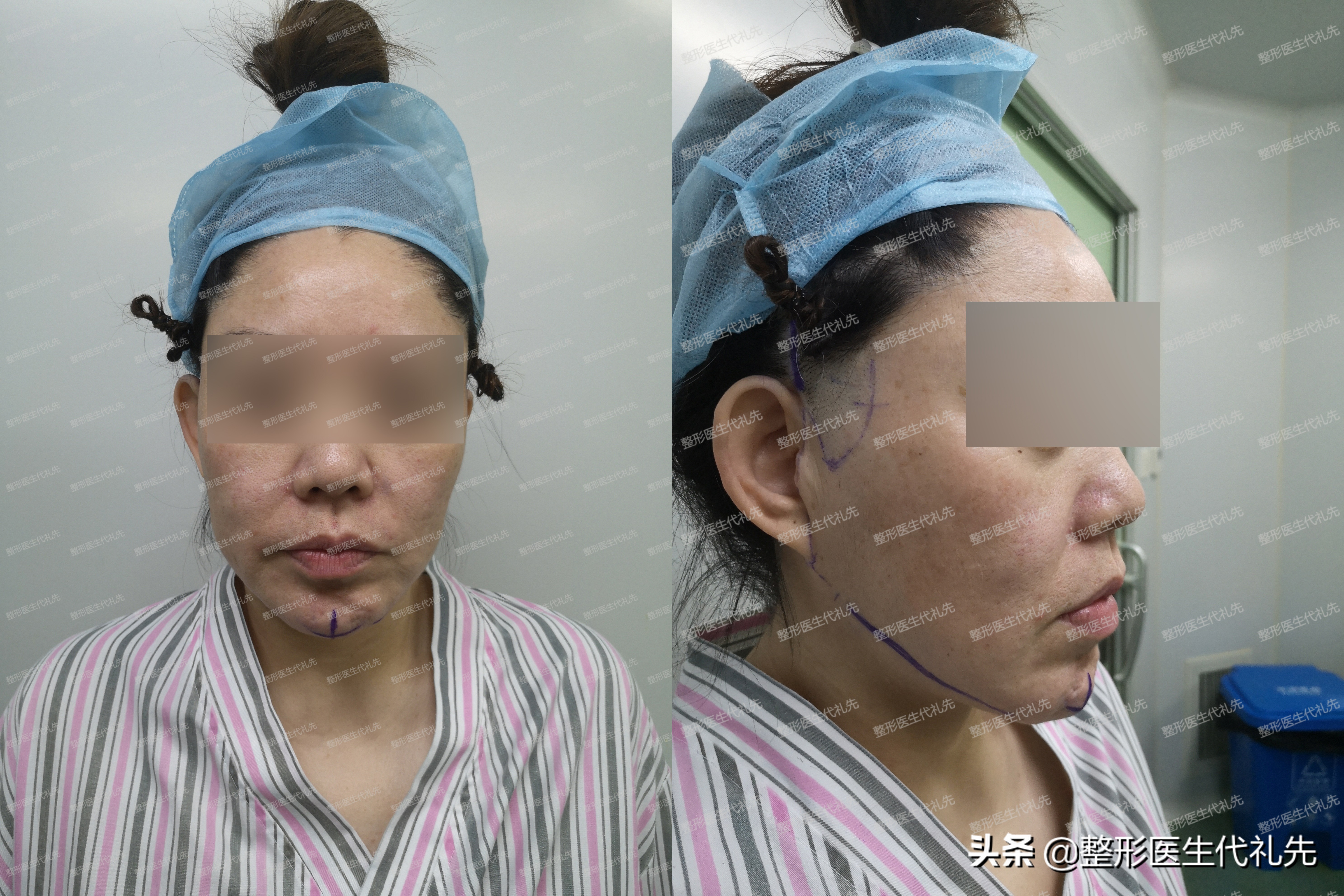 一秒消除法令纹,一次性治愈法令纹