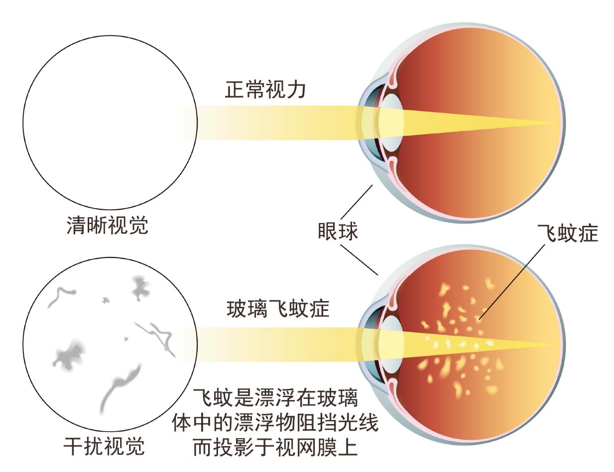 眼睛看见许多小黑点是飞蚊症吗,飞蚊症眼前有小黑点又看不清