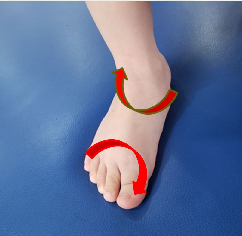 成人初期扁平足可以干预吗,两岁足外翻扁平足康复训练