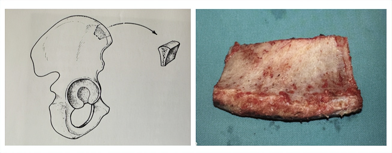 治疗骨折新技术,微创手术治疗骨折的方法