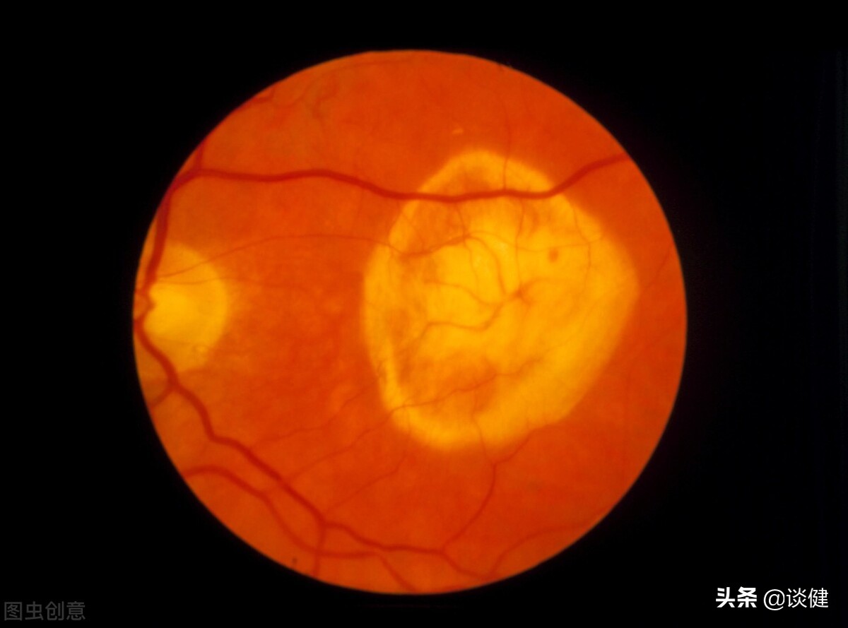 80岁眼睛模糊的原因及治疗方法,中老年眼睛模糊是什么原因引起的