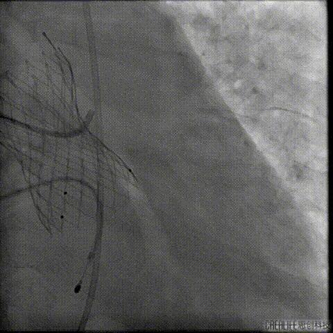 病例回顾与分享,腹膜后血肿介入治疗