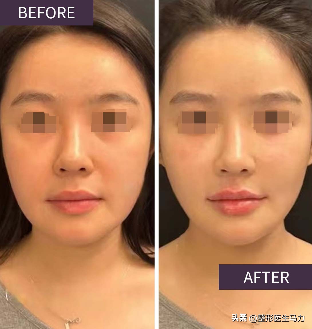 三甲医院注射玻尿酸都没事吧,三甲医院的医生注射玻尿酸专业吗