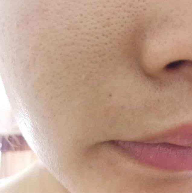 脸上红血丝毛孔粗大是什么原因,脸上毛孔粗大怎么改善小妙招