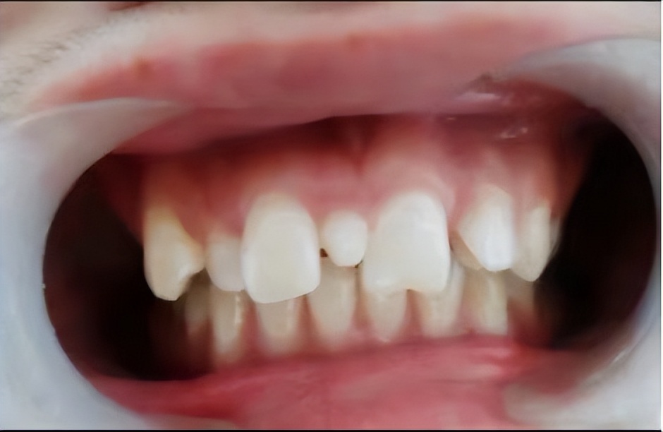 宝宝牙缝有点大这是好还是坏呢,为什么宝宝的牙缝很大