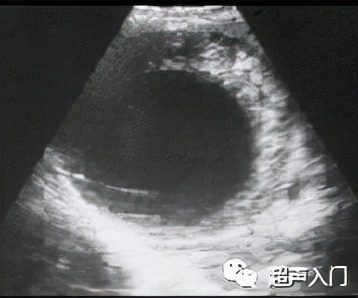 肝包虫病B超能检查出来吗?