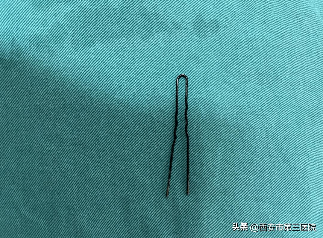 一枚发卡引发的微创手术…