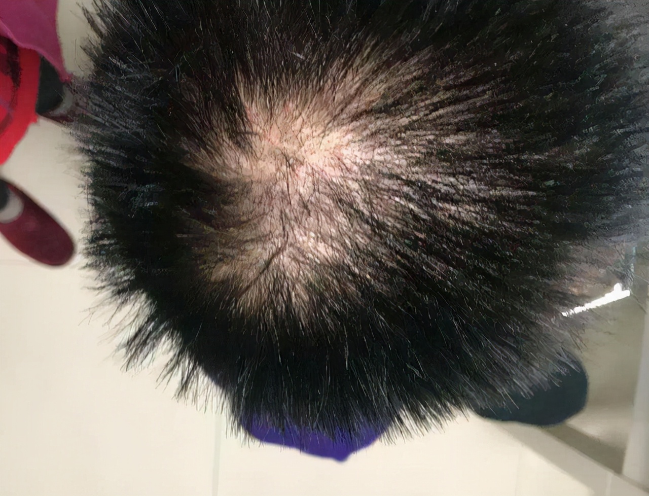 艾滋病出现的皮肤病不治会自愈吗,艾滋病潜伏期会单纯出现皮肤病吗