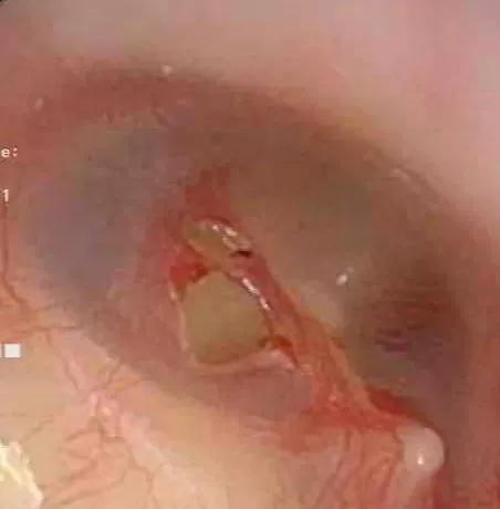 为什么有的人喜欢掏耳屎,喜欢掏耳屎是一种病态吗