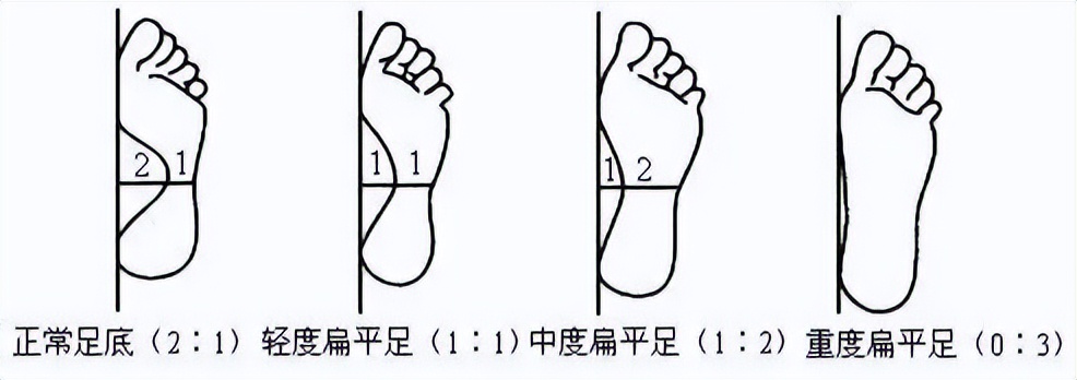 成人初期扁平足可以干预吗,两岁足外翻扁平足康复训练