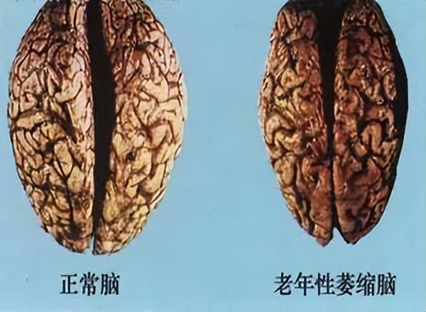 五行通脉汤治疗小脑萎缩都有哪些优势？