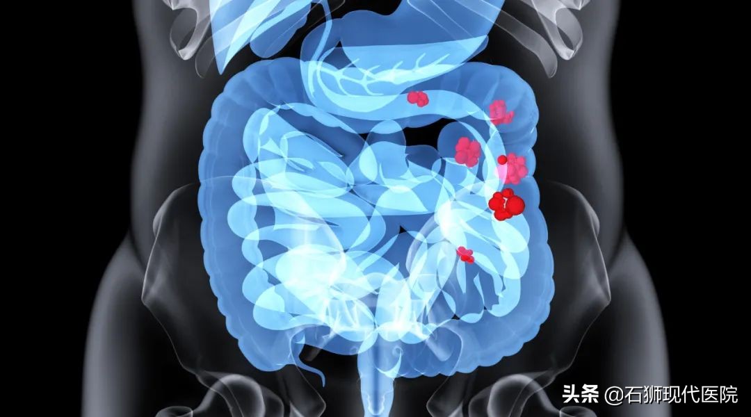 肛门有痔疮有什么症状,肛门痔疮症状有哪些