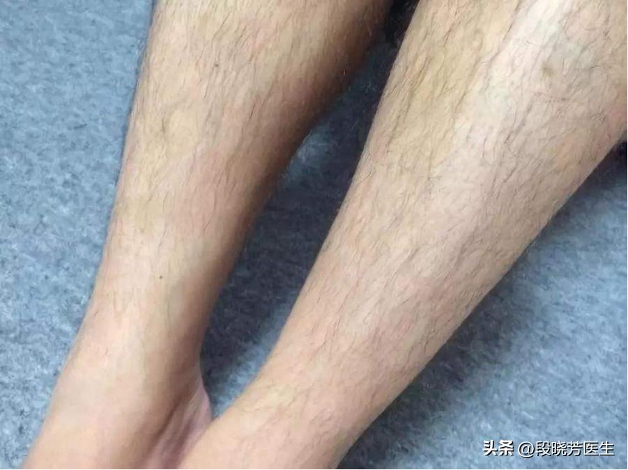 女孩子手臂多毛,鼻孔多毛怎么办