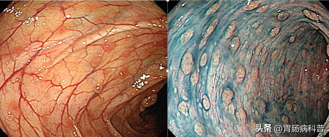 肠息肉四种表现,肠息肉什么样的容易癌变