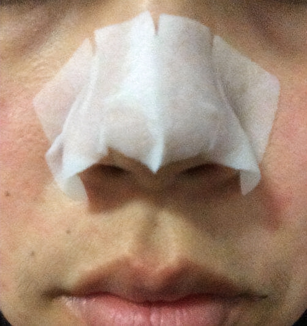 眉心鼻翼和下巴长粉刺为什么,鼻头上起粉刺什么原因引起的图片