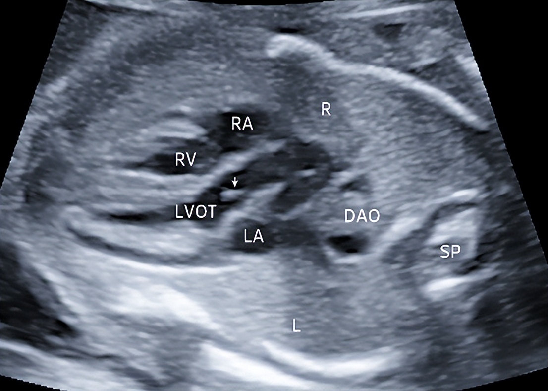 孕晚期i级产前超声检查是什么,孕中期超声产前检查
