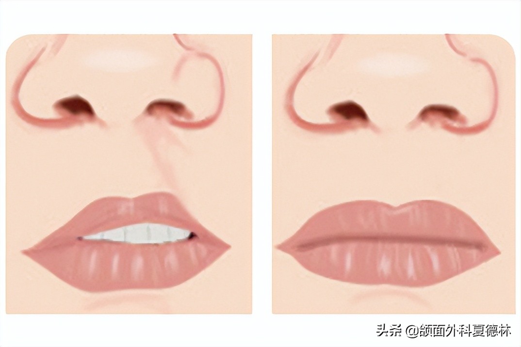 告别“天使的吻痕”——唇腭裂