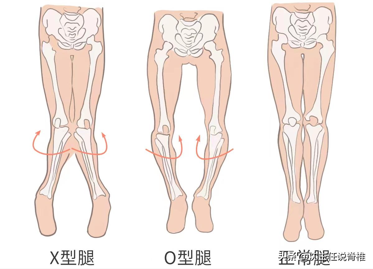 走路姿势不对导致扁平足,锻炼足弓改善扁平足