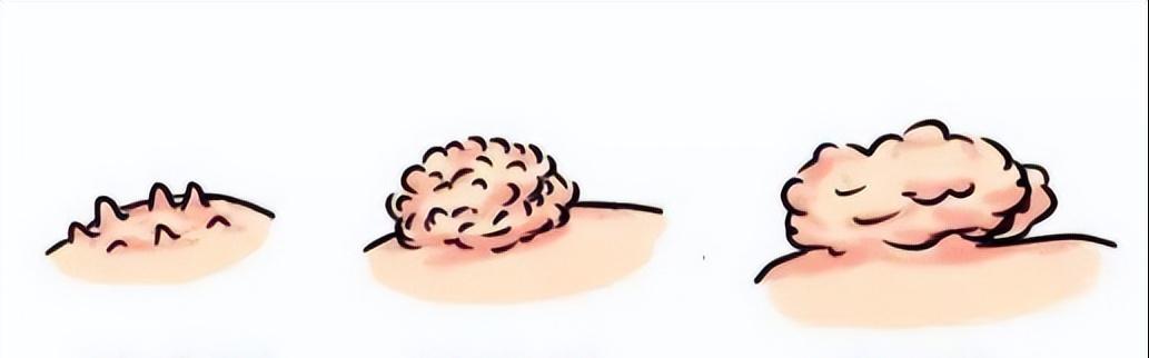 皮肤瘙痒起疙瘩越抓越多每年都犯,私部起疙瘩怎么办