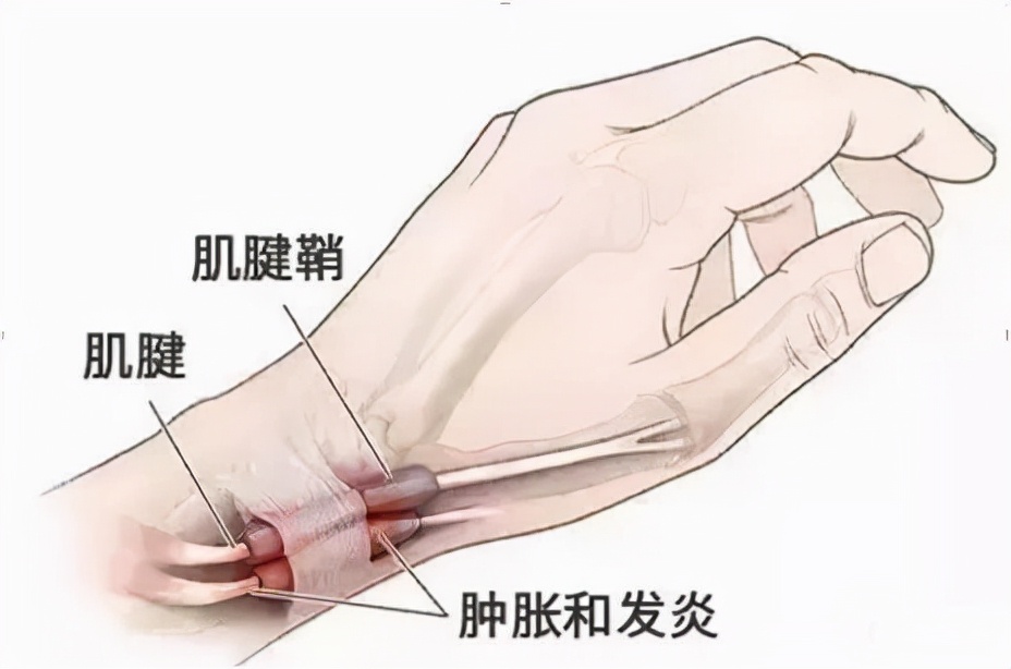 腕部筋疼啥原因,腕部疼痛如何治疗