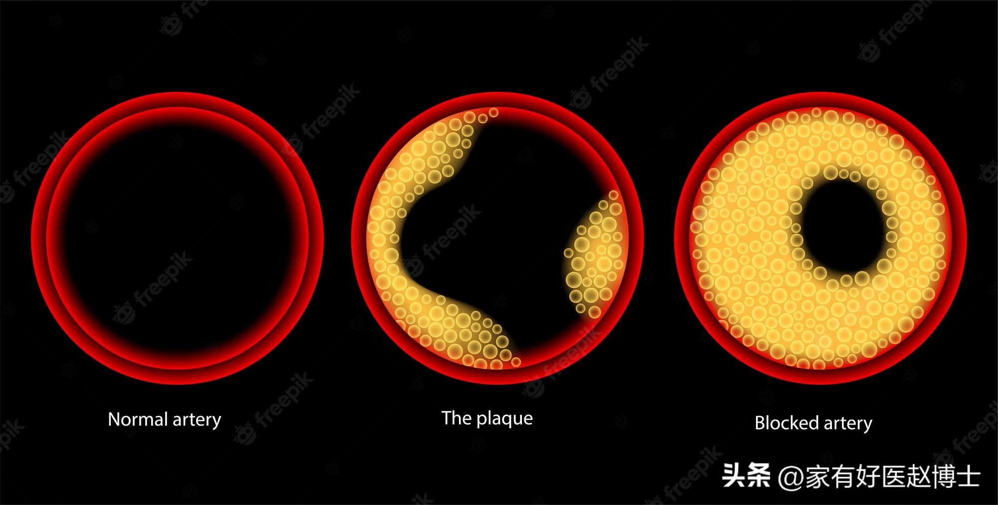 高密度胆固醇hdl偏低应该如何饮食,高密度脂蛋白胆固醇hdl偏低0.85