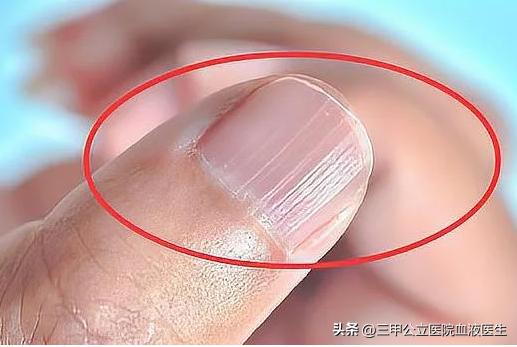 手指甲发白没有月牙有明显竖纹,手指甲有月牙和条纹是什么原因