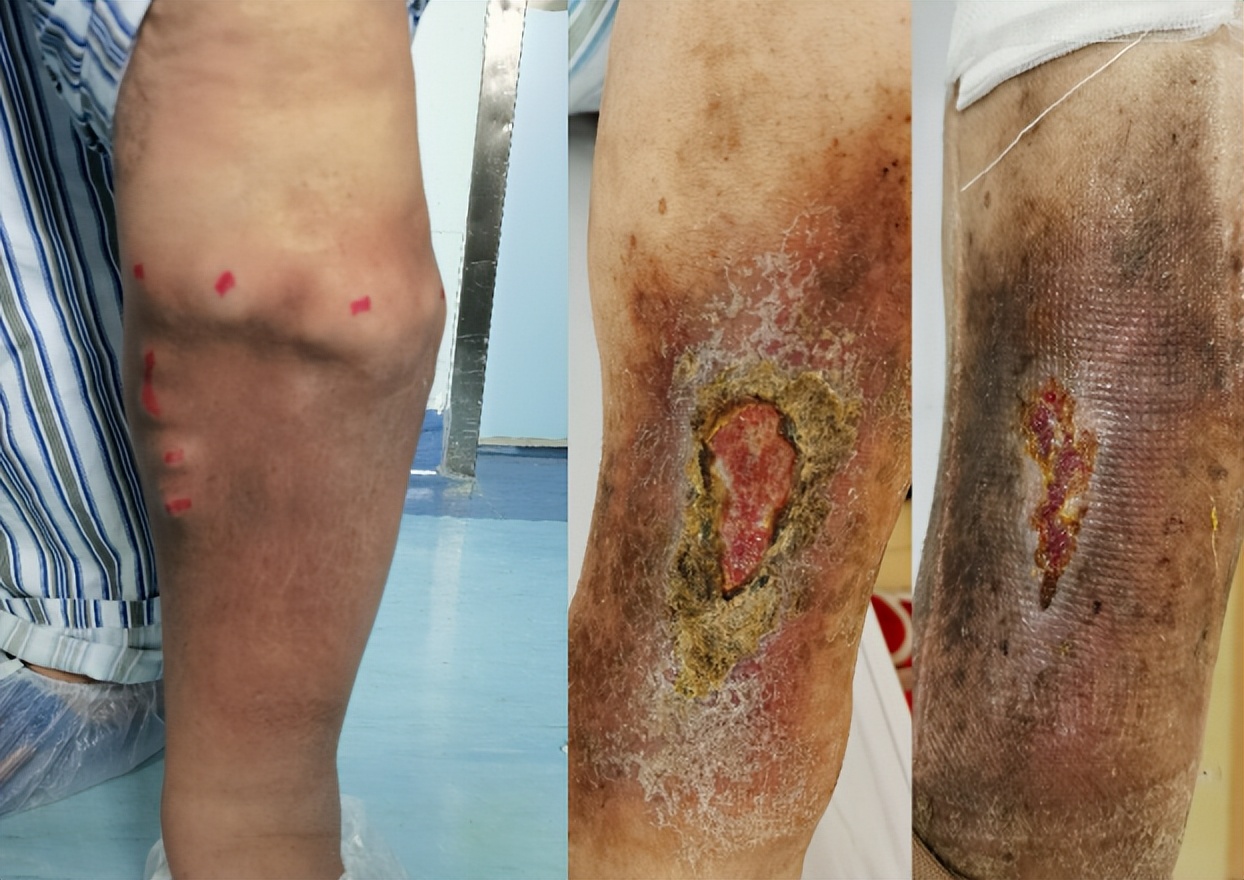 胃底静脉曲张破裂出血了怎么办,下肢静脉曲张破裂出血怎么办