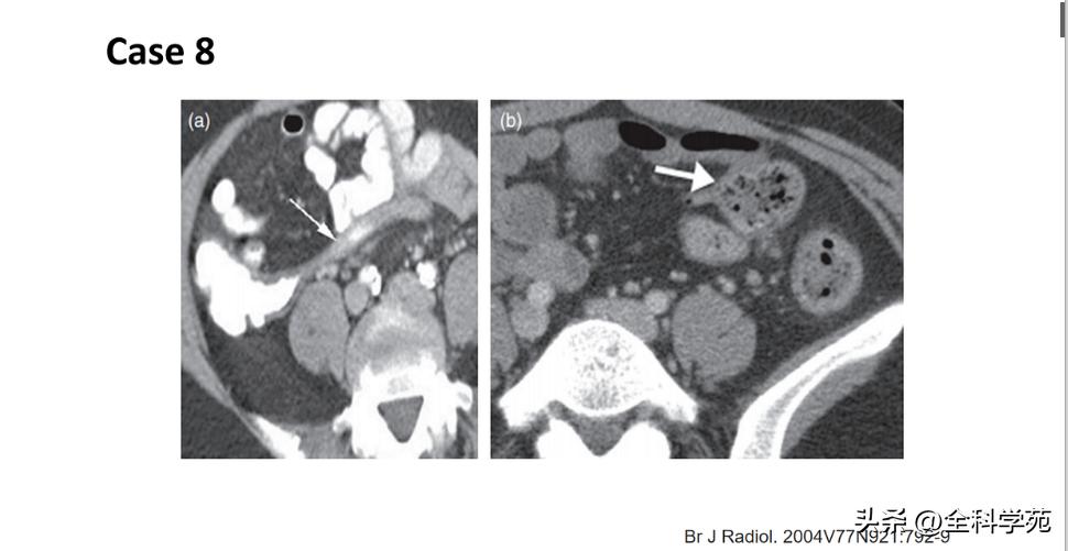阑尾炎的讲解,关于阑尾炎的讨论总结