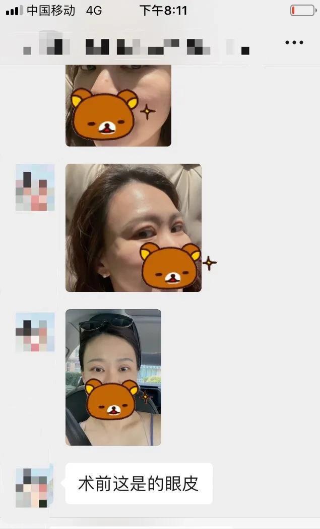 双眼皮修复改扇形双眼皮,平行双眼皮能改成开扇形双眼皮吗