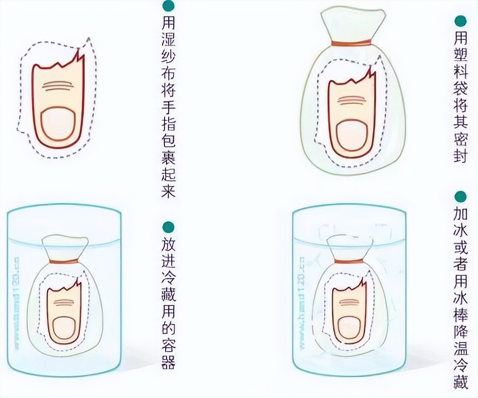 一瞬间，4根手指没了！浙一专家：意外来临时，千万记得这样做