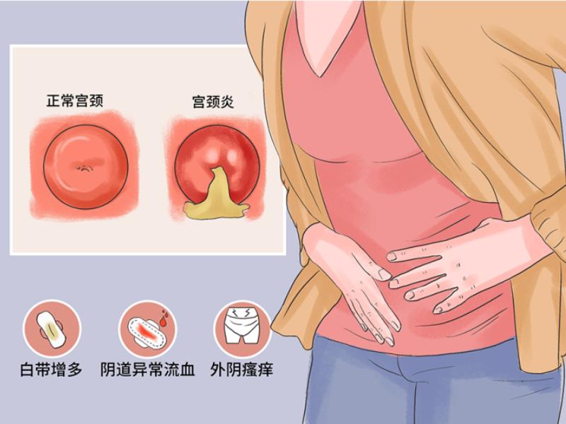 远离宫颈炎的五大妙招,宫颈炎怎么才能预防不复发