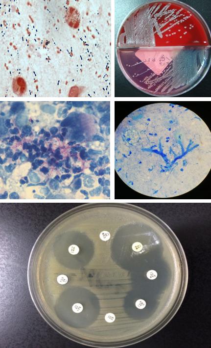 免疫缺陷病会并发什么病,什么是免疫缺陷肺部感染