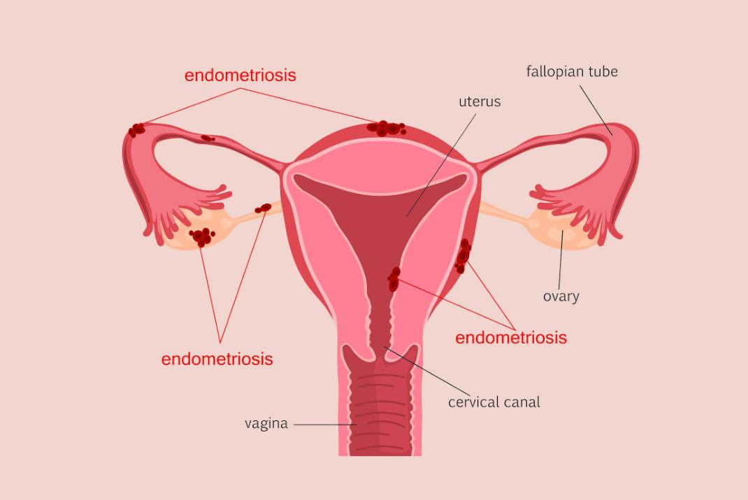 子宫腺肌症吃哪种药能缓解疼痛,子宫腺肌症疼痛难忍吃什么药