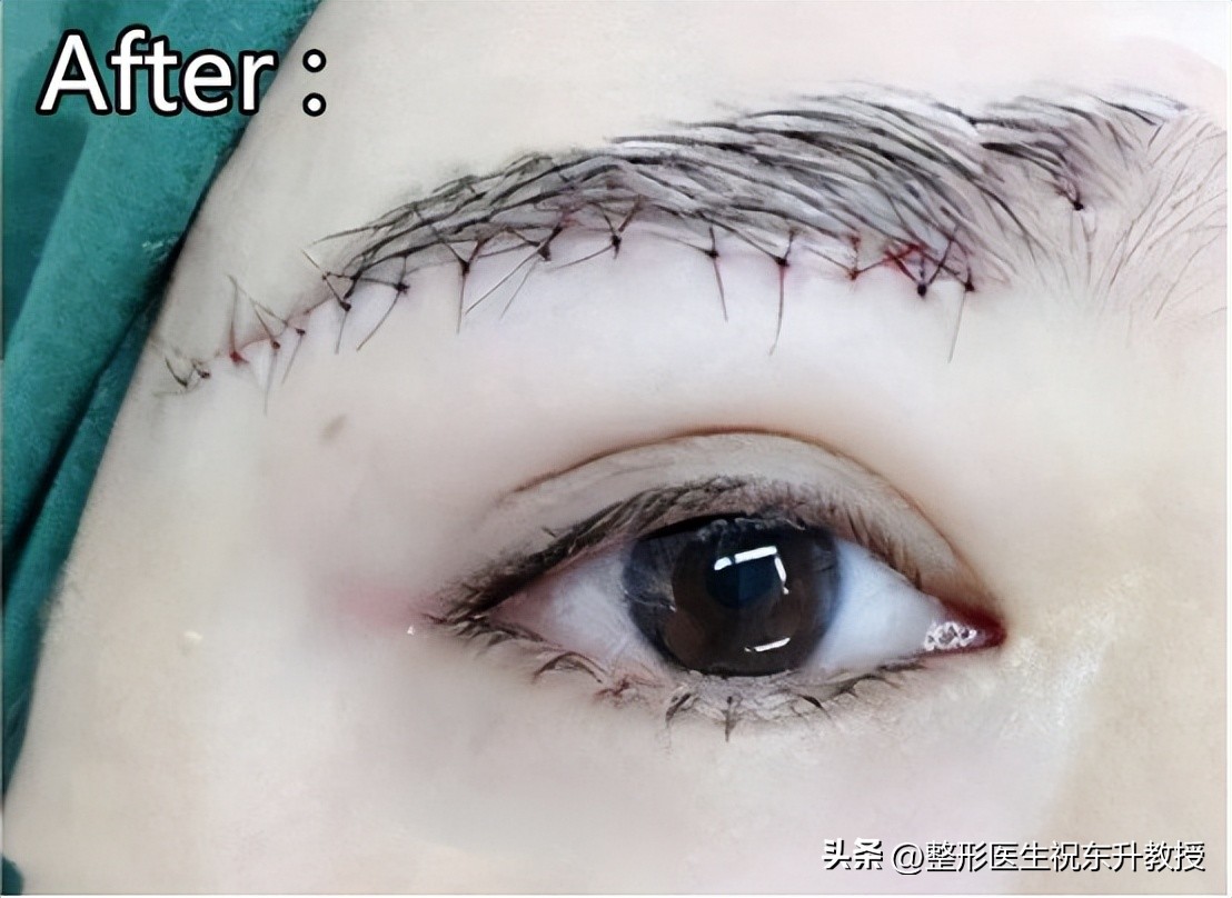 提眉手术恢复全过程,提眉手术后的真实感受