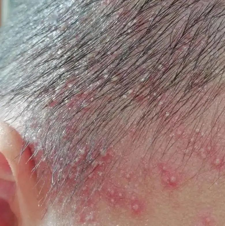 儿童冬天长痱子的原因,冬天长痱子了怎么治最有效