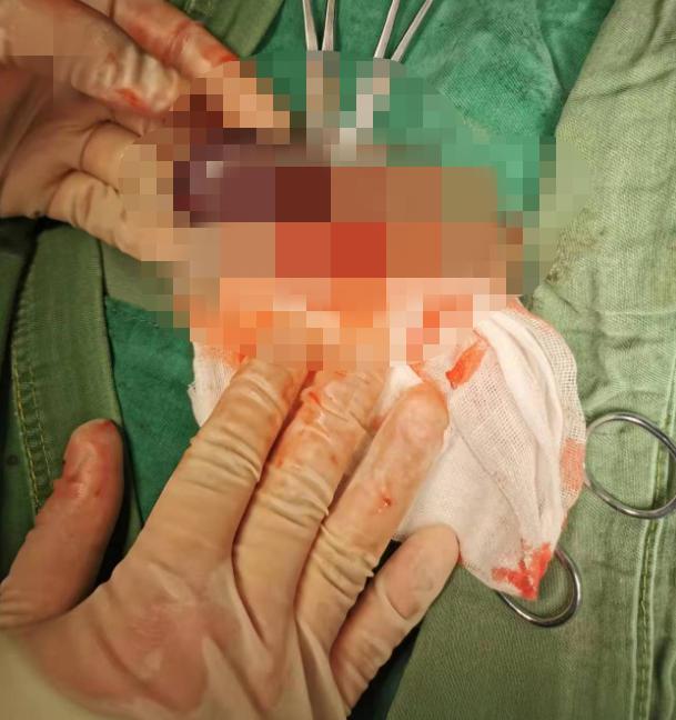 睾丸扭转16个小时,轻度睾丸扭转自愈