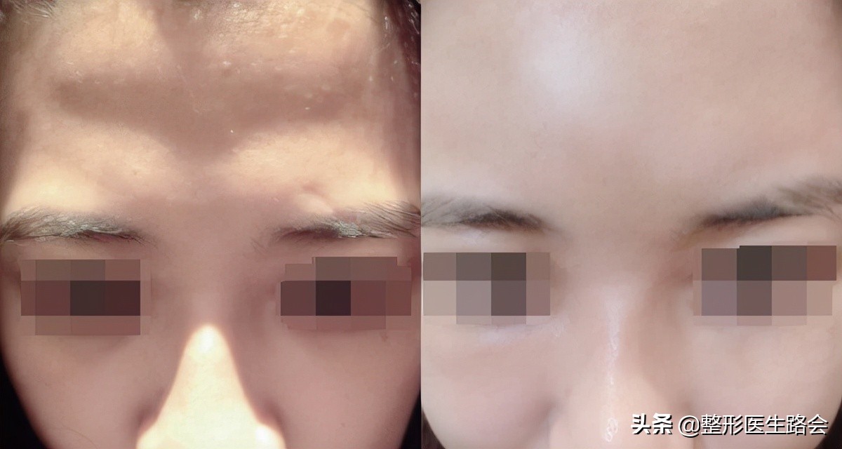 自体脂肪丰太阳穴会不舒服吗,自体脂肪丰额头好还是玻尿酸好