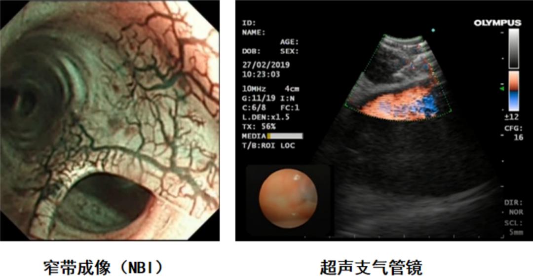 咯血一定要做支气管镜吗,支气管镜的注意事项