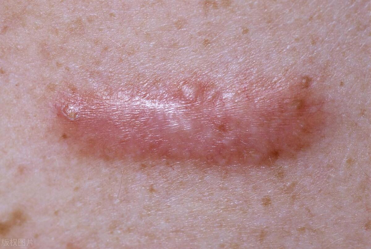 疤痕疙瘩知识科普|如何有效去除疤痕？