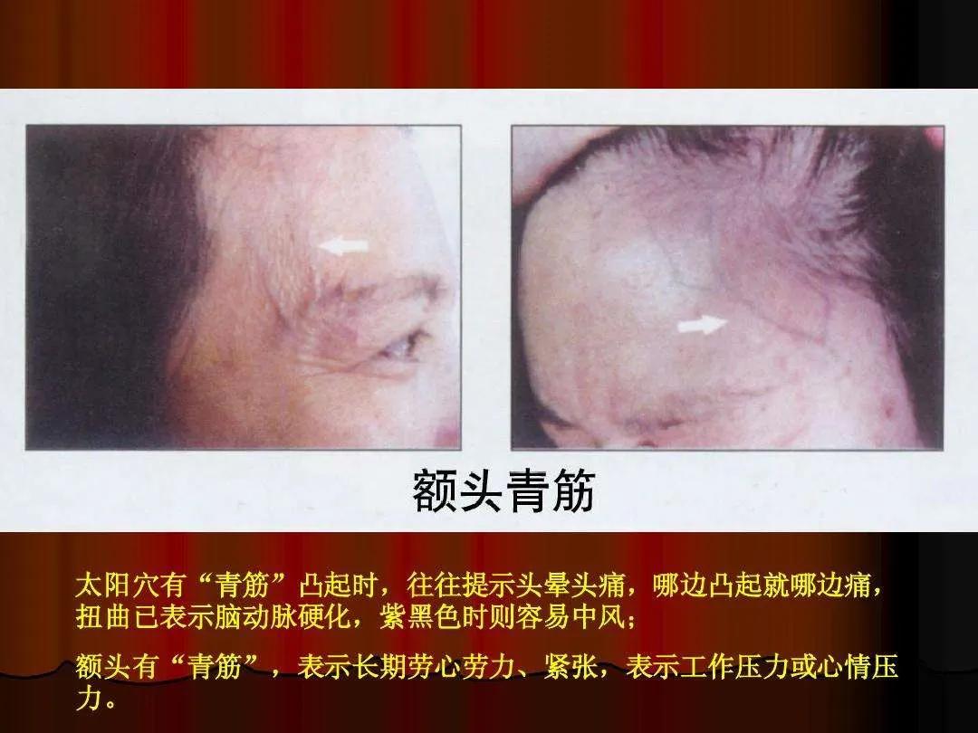 额头血管突出怎么回事,额头血管凸起能治吗