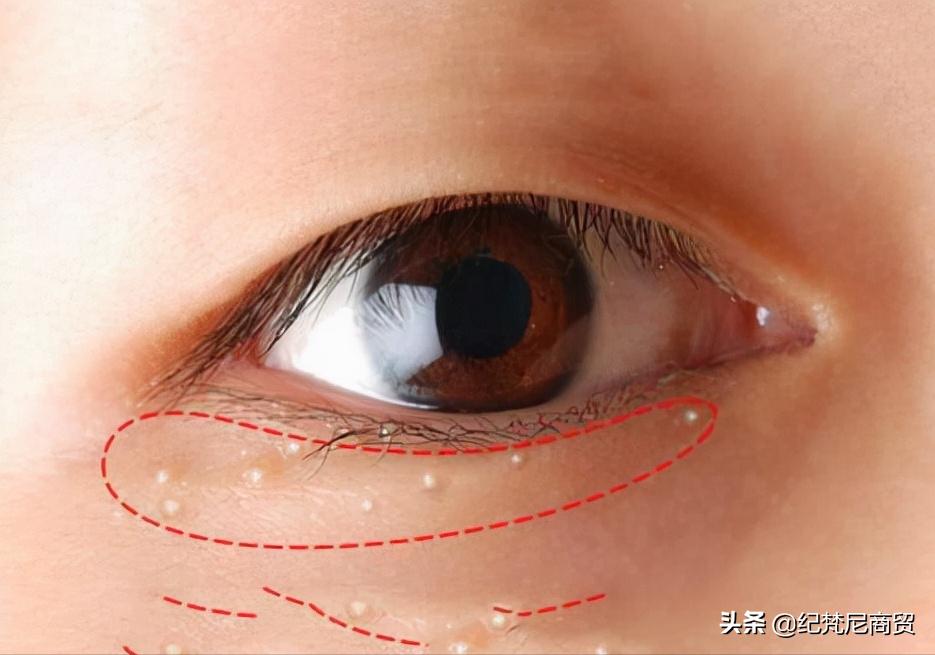 脂肪粒是怎样造成的如何消除,脖子上的脂肪粒消除最快方法